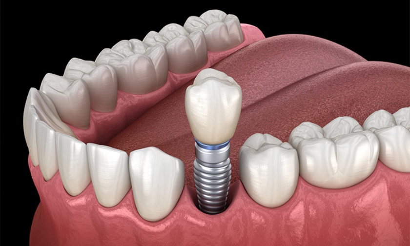 Dental Implants For Seniors: Is It Ever Too Late?